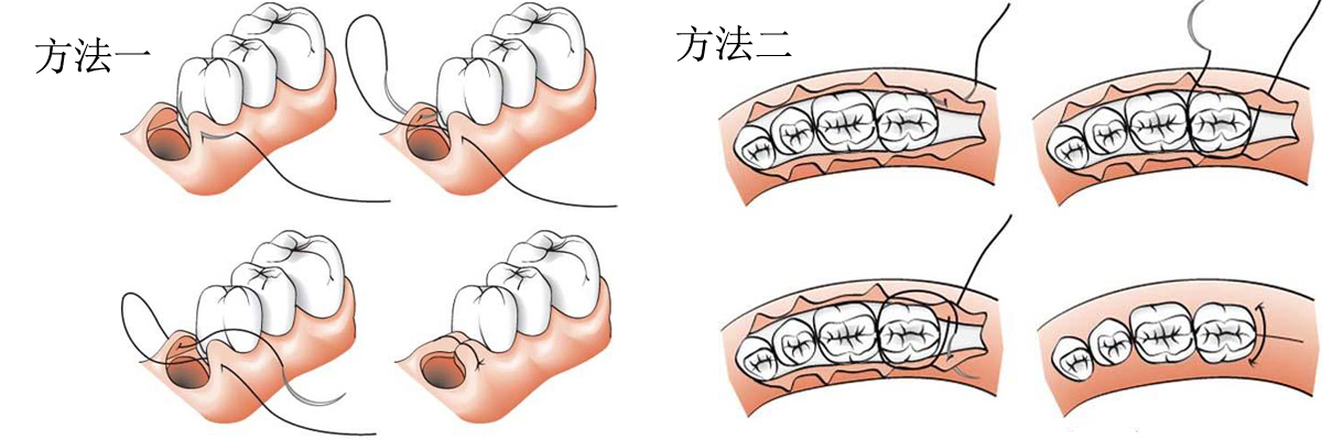 牙周治療手術(shù)縫合線(xiàn)縫合方法示意圖.jpg