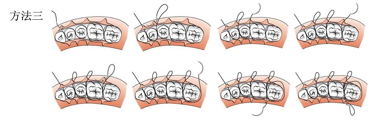 醫用手術(shù)縫合線(xiàn)縫合方法.jpg